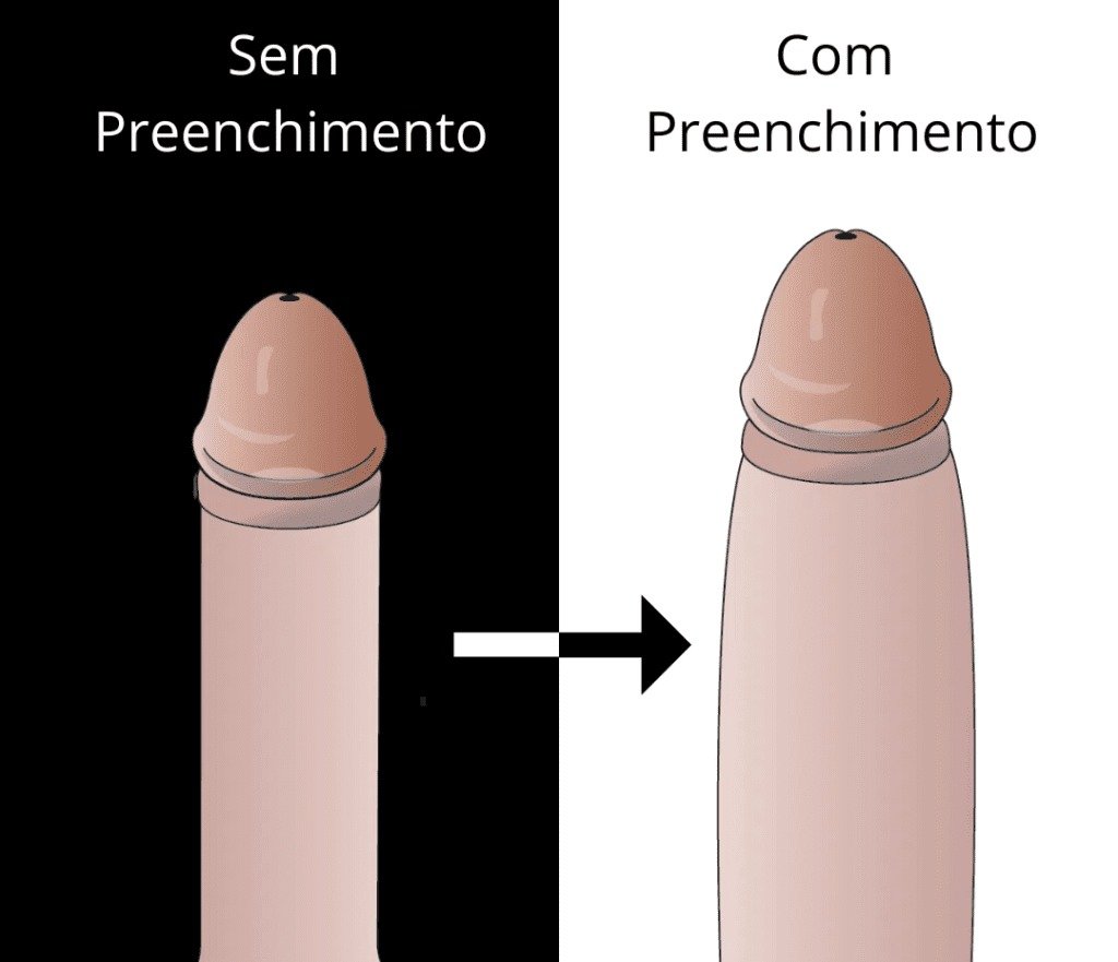 preenchimento peniano curitiba 1