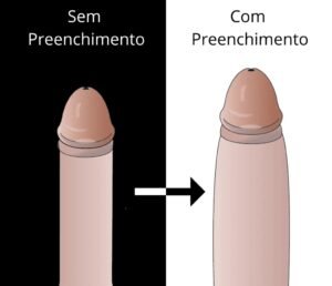 preenchimento peniano curitiba